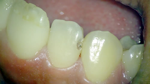 歯質の下に潜む虫歯