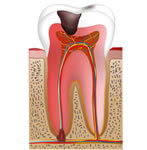 根管治療(歯の神経治療)