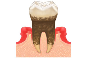 歯周病治療