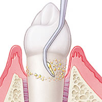 歯周病