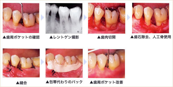 松戸で歯周病治療が評判の歯科 歯ぐきから血が出る 歯ぐきが腫れる