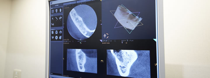 歯科用CTを活用した精密診断
