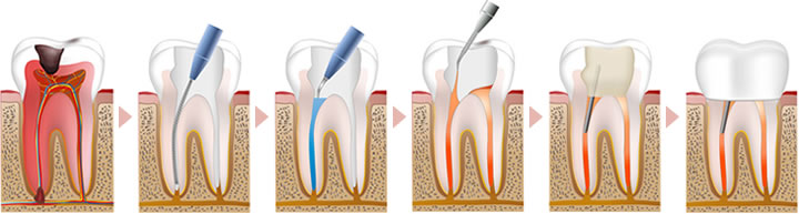歯の神経治療