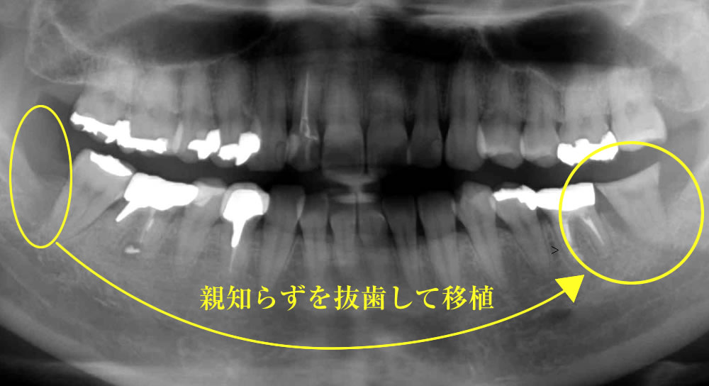 親知らずの移植