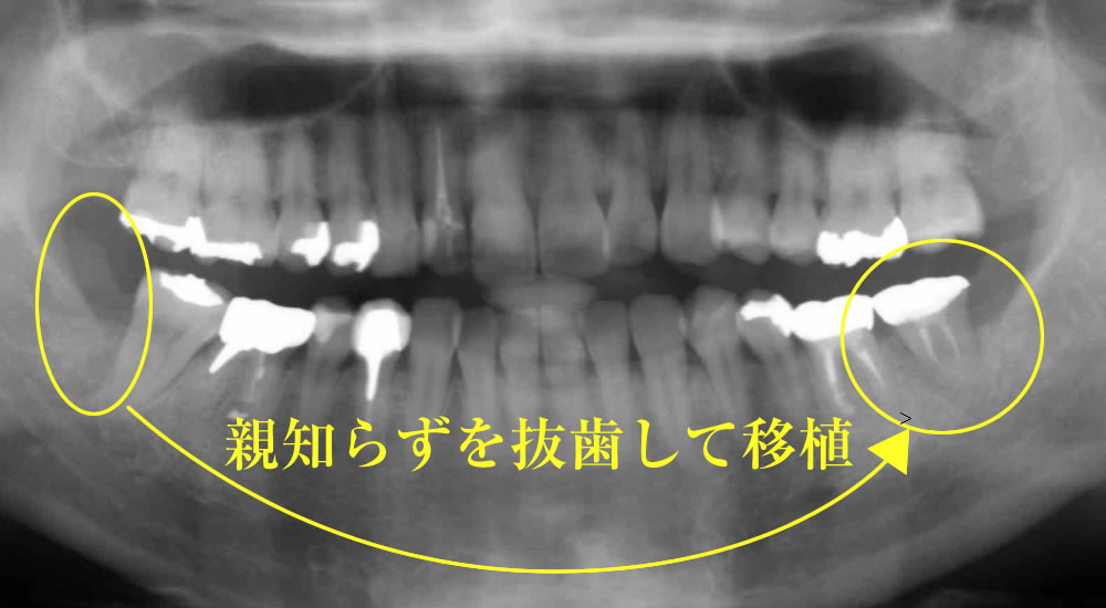 親知らずの移植