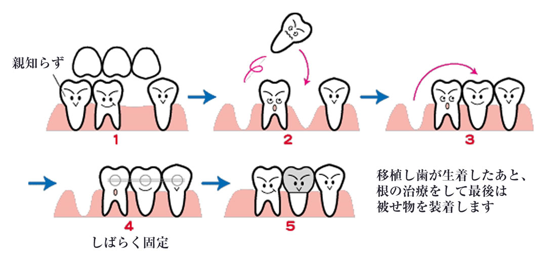 親知らずの移植(自家歯牙移植)｜インプラントの代わりに！｜松戸デンタル