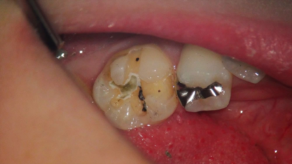 銀歯の除去