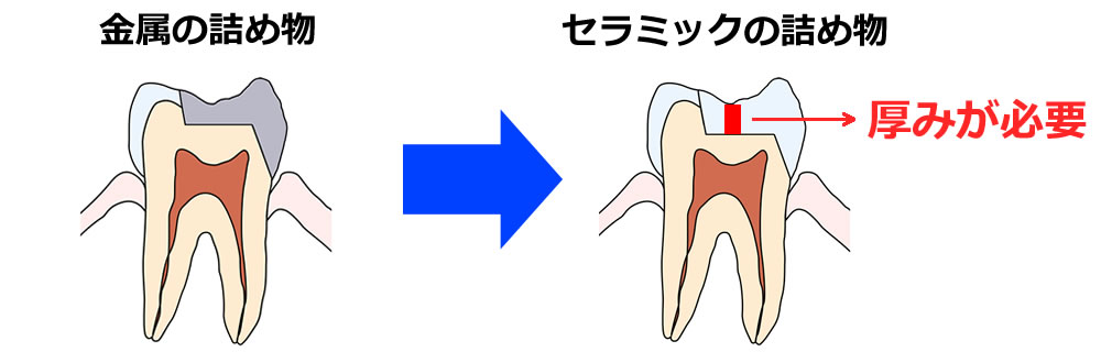 セラミックとコンポジットレジンで修復する際の比較