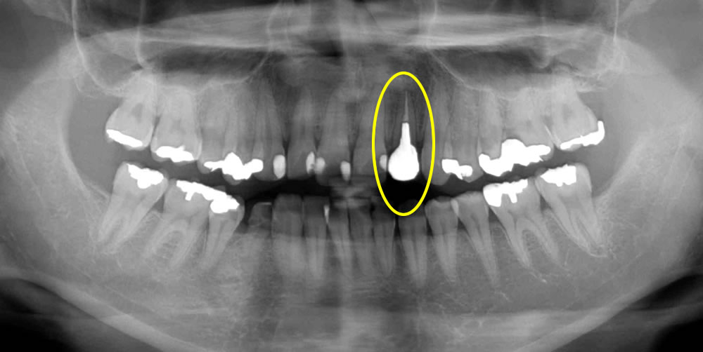 前歯のレントゲン