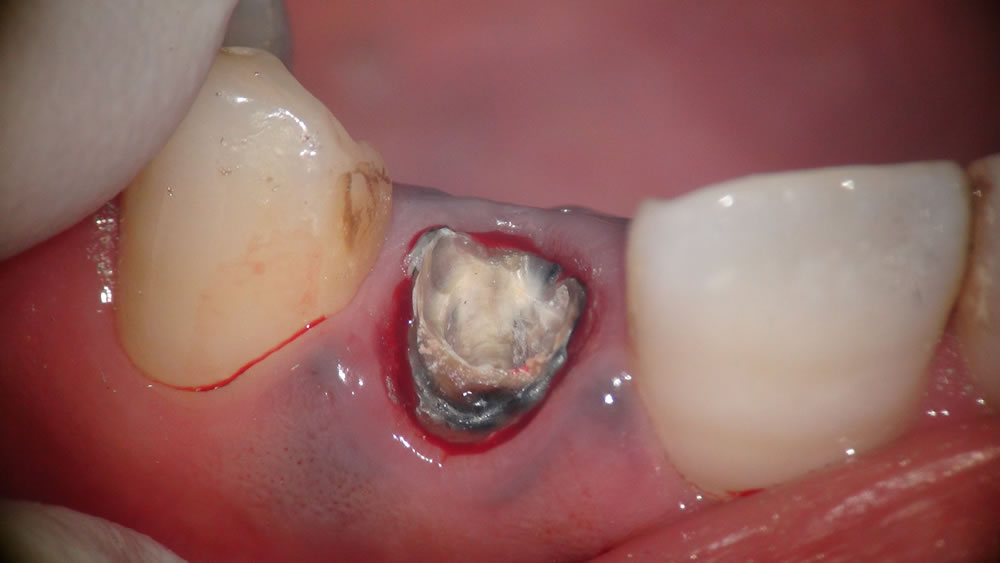 前歯のエクストリュージョン