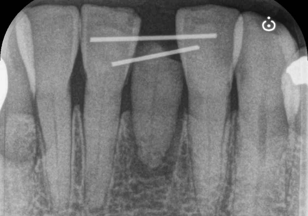 歯の固定
