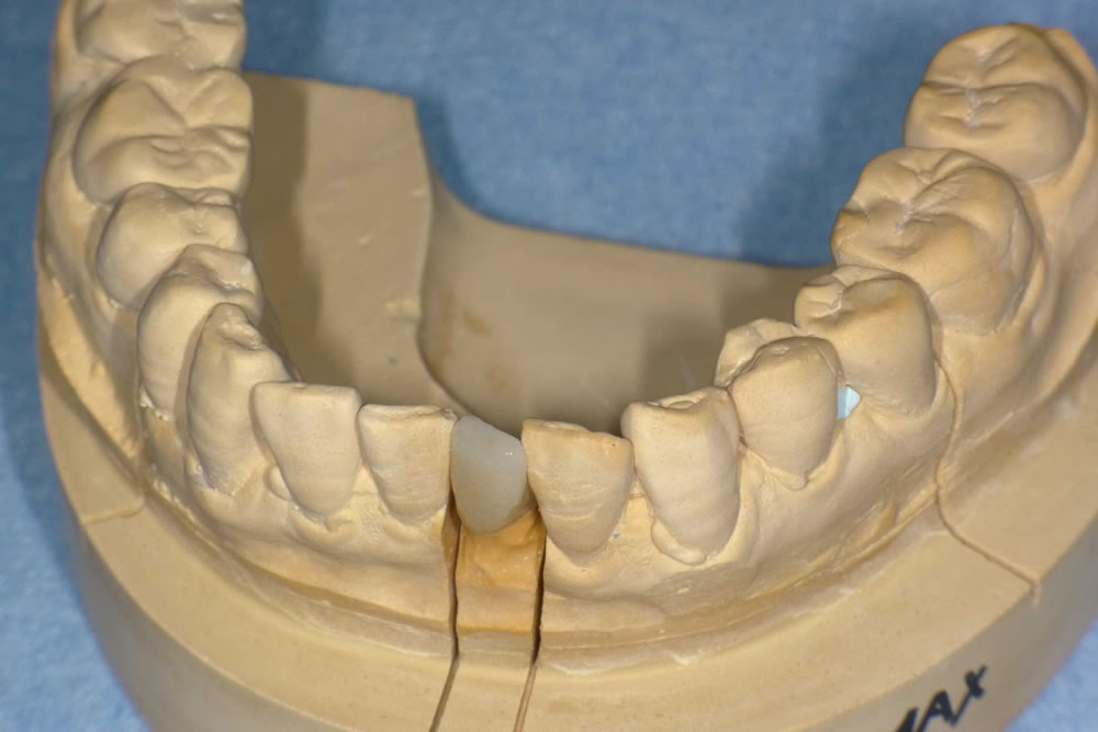 前歯のオールセラミックの被せ物