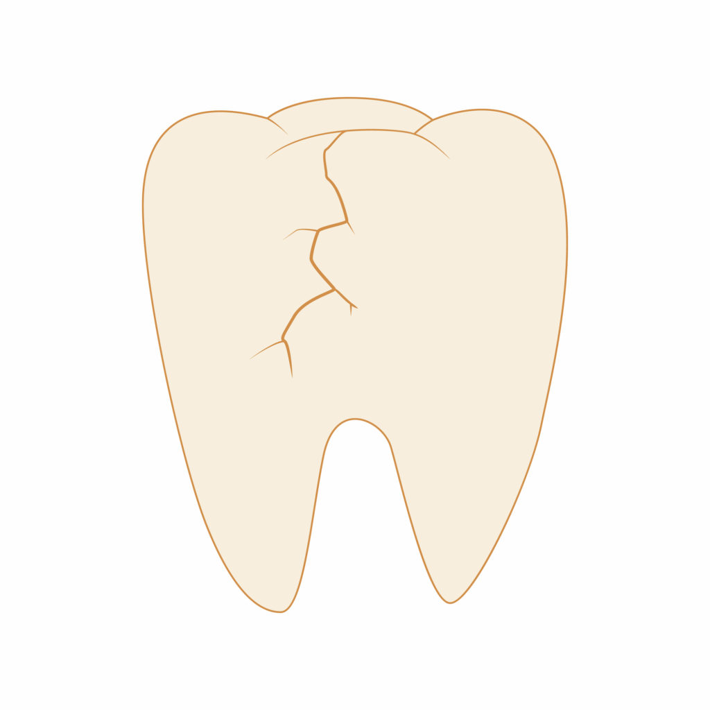 歯のヒビと根管治療